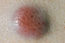 skin cancer symptoms besides new moles