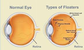 If you have severe myopia (nearsightedness) or have had eye surgery or an eye injury, you have a higher chance of having a retinal tear. Is There A Cure For Eye Floaters Quora