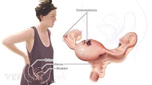 The uterus is a muscular female organ located in the pelvis. Lower Left Back Pain From Internal Organs