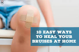 heal your bruises at home