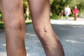 8 natural remedies for blood clots. Varicose Veins And Blood Clots In Your Leg The Iowa Clinic