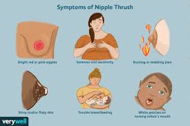 thrush on s symptoms treatment