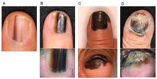 nail apparatus melanoma