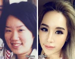 local celebrities with plastic surgery