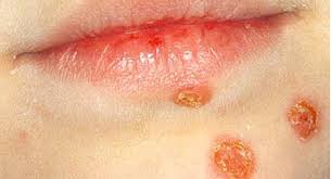 conious skin infection