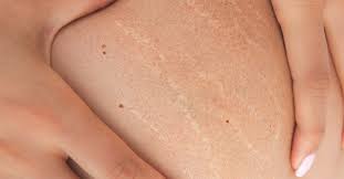 Stretch Marks Do They Go Away gambar png