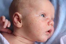 baby eczema vs acne symptoms causes