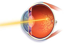 retinal laser therapy retina laser