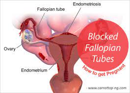 Check spelling or type a new query. Blocked Fallopian Tubes And How To Get Pregnant Easily Carrot Top Drugs Limited