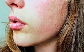 winter skin diseases prevention and