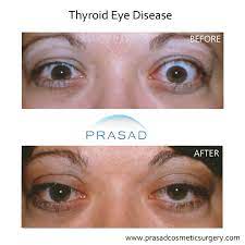 thyroid eye disease surgery graves eye