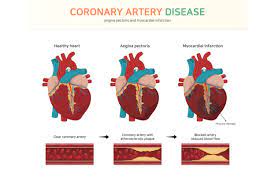 coronary artery disease in las cruces