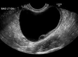 I was diagnosed as having a 9.1 cm ovarian cyst in my right ovary two days ago. Guidance For The Diagnosis And Management Of Ovarian Cysts Clinical Advisor