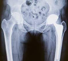 hip replacement surgery procedure