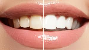 is teeth whitening safe north sydney