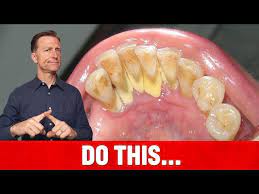 top remedy for dental plaque tartar