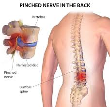 pinched nerves specialists in nyc new