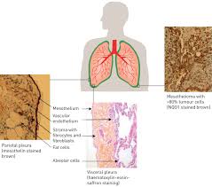 Symptoms · chest pain · painful coughing · shortness of breath · unusual lumps of tissue under the skin on your chest · unexplained weight loss. Malignant Pleural Mesothelioma History Controversy And Future Of A Manmade Epidemic European Respiratory Society