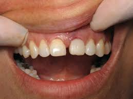 How does it feel to get all your teeth pulled and get dentures? Dental Implants How Long Does It Take Ramsey Amin Dds