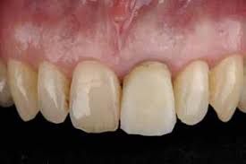Ponekad pacijenti misle da su nakon izrade krunica ili mosta njihovi zubi. Http Www Hkdm Hr Pdf 2015 Dd 09 Dd 09 2015 Pdf