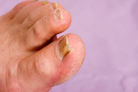 what is foot fungus experts advise