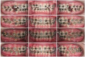 After awhile your pain should subside. Accelerated Orthodontic Treatment And Wire Sequencing