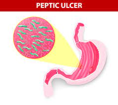 ulcer symptoms report them to your