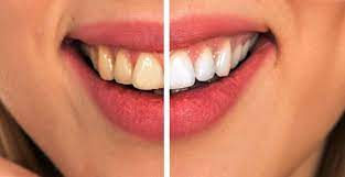 Learn how to whiten and clean teeth with this article focused on dental care, healthy teeth, flossing, and teeth whitening. 8 Simple Ways To Naturally Reverse Cavities And Heal Tooth Decay