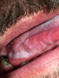 In the early stages, mouth cancer may cause no pain. Self Oral Cancer Screening Socs Education Program School Of Dentistry Lsu Health New Orleans