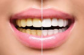 how long does teeth whitening last