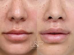 lip lift before and after photo gallery