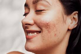 acne e skin cetaphil singapore