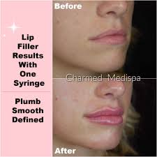 lip filler a variety of techniques