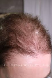 scalp micropigmentation for women the