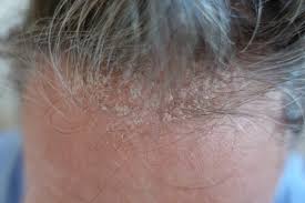 scalp seborrheic dermais treatment
