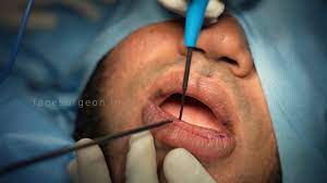 lower lip reduction surgery