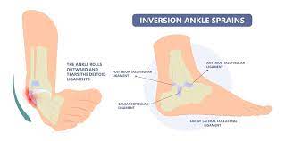 how and why does inversion ankle sprain
