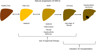 Discover the causes of cirrhosis, diagnosis, prevention, and how to. New Therapeutic Strategies In Nonalcoholic Fatty Liver Disease A Focus On Promising Drugs For Nonalcoholic Steatohepatitis Springerlink