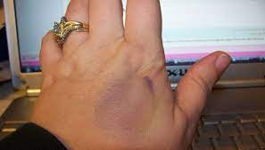 how to make a fake bruise with markers