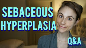 sebaceous hyperplasia q a with a