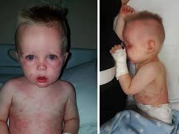 The issue is that covid can cause a wide variety of skin signs and symptoms, which is why there has been a delay in recognising that these various skin in this blog we will focus on the three main types of skin rashes associated with covid: Borehamwood Mum S Warning After Son S Rash Turned Out To Be Deadly Kawasaki Disease Hertslive
