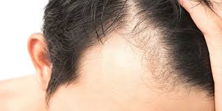 alopecia areata hair loss treatment