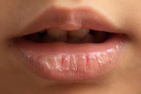 natural remes for chapped lips