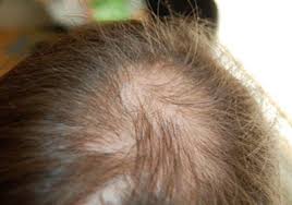 hair loss and demodex mites ungex