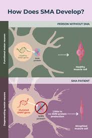 spinal muscular atrophy sma overview