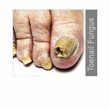 toes nail fungus treatment in