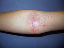 flexural eczema symptoms causes