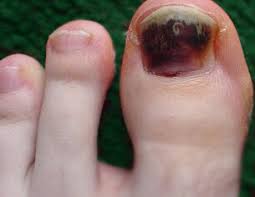 expert treatment for black toenail in