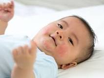Image result for Is hydrocortisone cream safe for babies