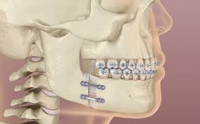 jaw surgery orthognathic surgery in